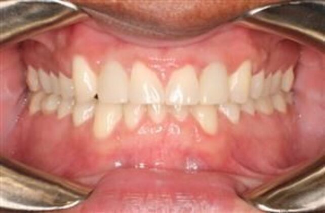 Orthodontics : Darius - Braces - After