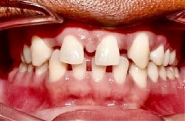 Orthodontics : Darius - Braces - Before