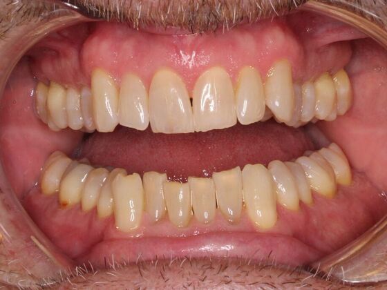 Orthodontics : Dave - Invisalign - Before