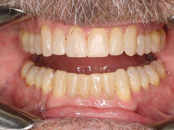 Orthodontics : Dave - Invisalign - After