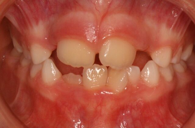 Orthodontics : Hank - Braces - Phase 1 Complete - Before