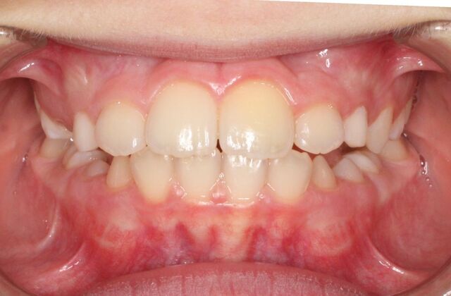 Orthodontics : Hank - Braces - Phase 1 Complete - After