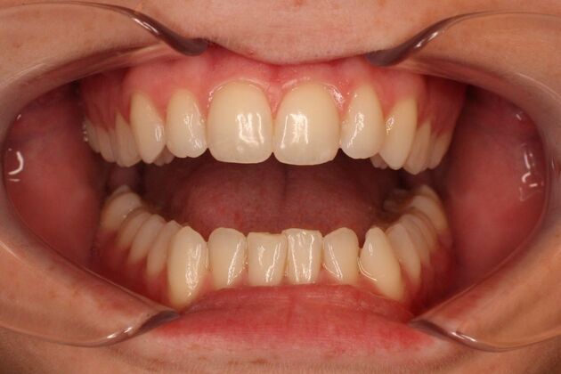 Orthodontics : Emma-Beth - Invisalign - Before