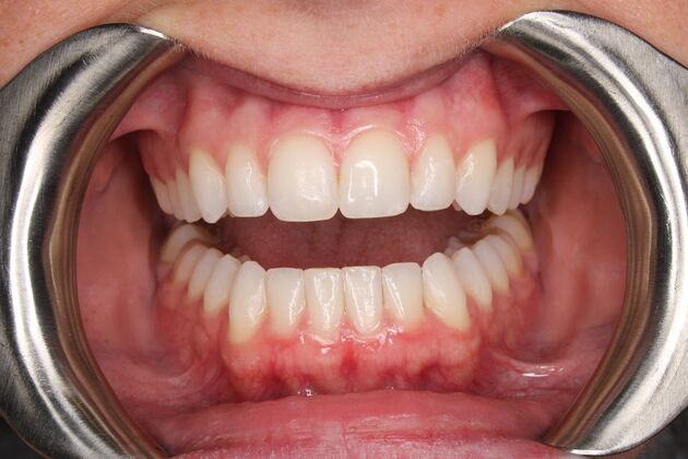 Orthodontics : Emma-Beth - Invisalign - After