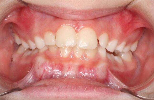 Orthodontics : Lucy - Braces - Phase 1 & 2 - Before