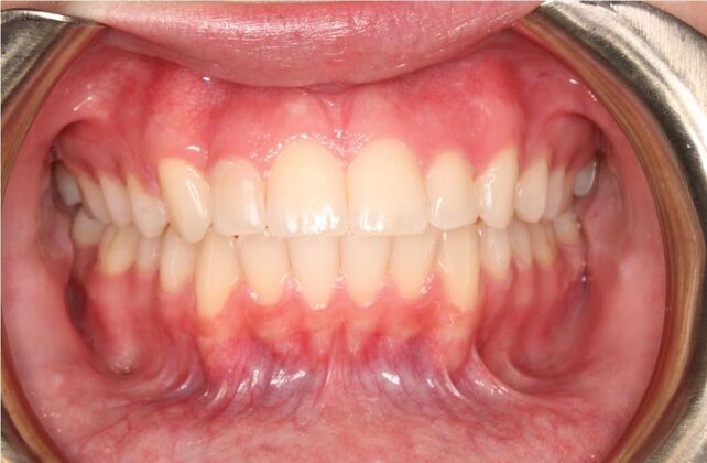Orthodontics : Lucy - Braces - Phase 1 & 2 - After