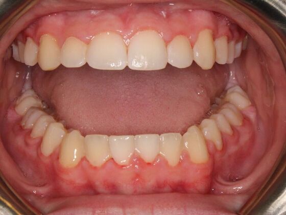 Orthodontics : Nate - Braces - Phase 1 & 2 - After