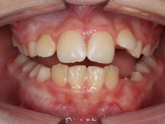 Orthodontics : Nate - Braces - Phase 1 & 2 - Before