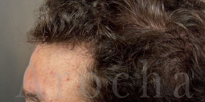 FUT Hair Restoration: Case 45 - After