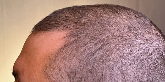 FUT Hair Restoration: Case 45 - Before