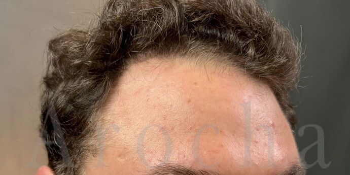 FUT Hair Restoration: Case 45 - After