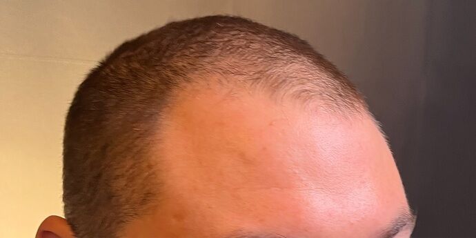 FUT Hair Restoration: Case 45 - Before