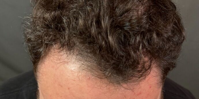 FUT Hair Restoration: Case 45 - After