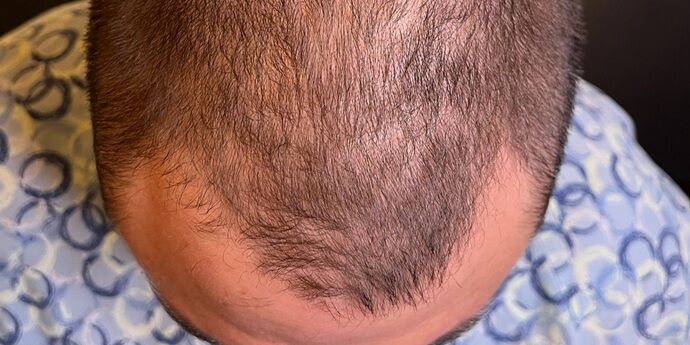 FUT Hair Restoration: Case 45 - Before