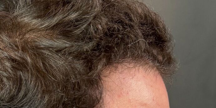 FUT Hair Restoration: Case 45 - After