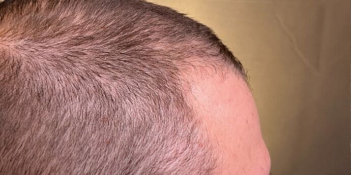 FUT Hair Restoration: Case 45 - Before