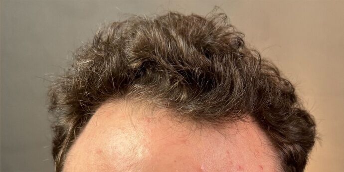 FUT Hair Restoration Case 45 - After