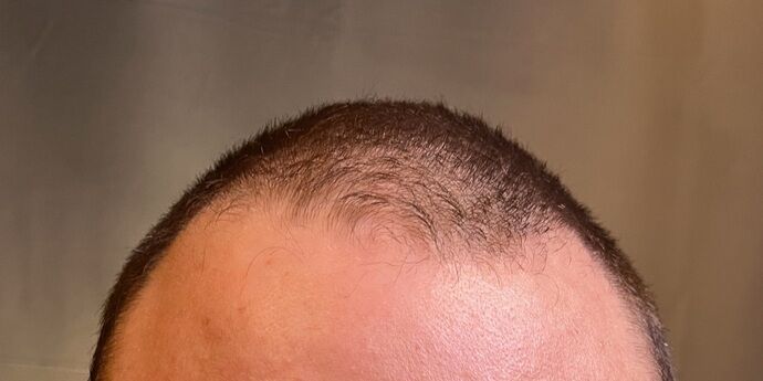 FUT Hair Restoration Case 45 - Before
