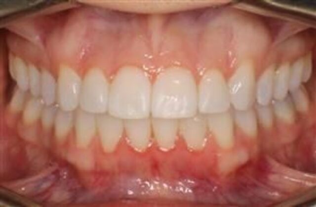 Orthodontics : Natasha - Invisalign - After
