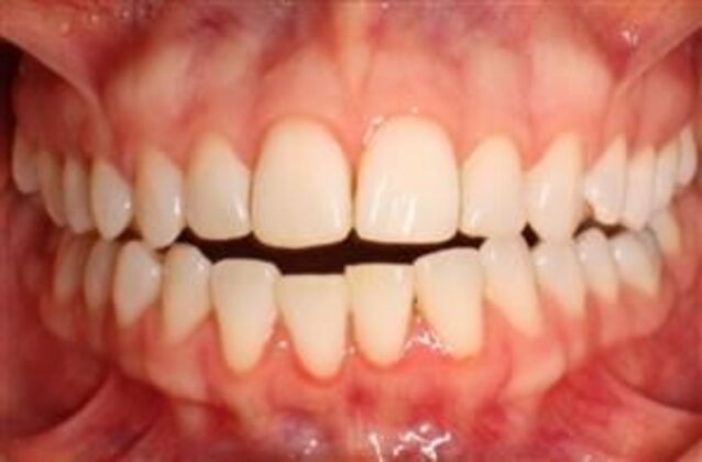 Orthodontics : Natasha - Invisalign - Before