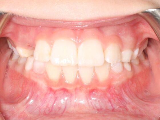 Orthodontics : Josie - Invisalign - Phase 1 Complete - After