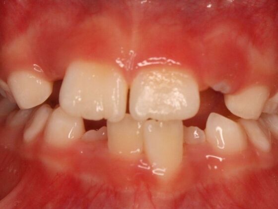 Orthodontics : Josie - Invisalign - Phase 1 Complete - Before