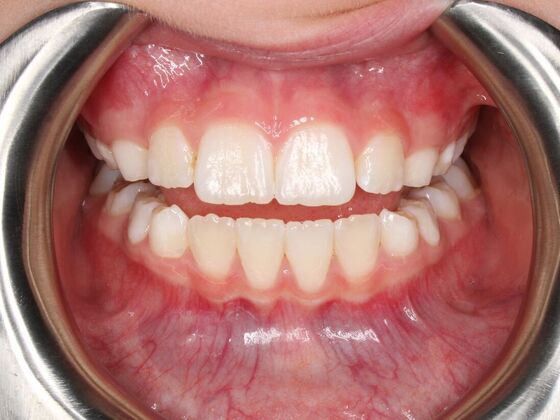 Orthodontics : Josie - Invisalign - Phase 1 Complete - After