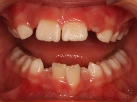 Orthodontics : Josie - Invisalign - Phase 1 Complete - Before