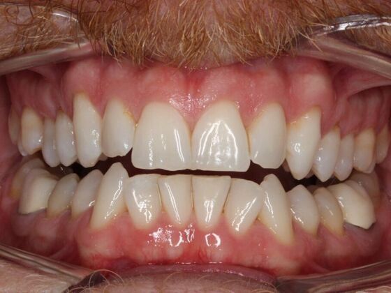 Orthodontics : Robby - Invisalign - Before