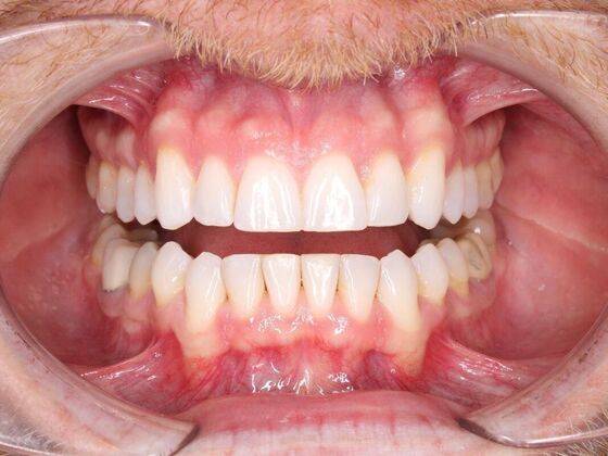 Orthodontics : Robby - Invisalign - After