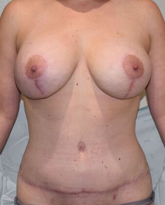 Mommy Makeover Case 321 - After