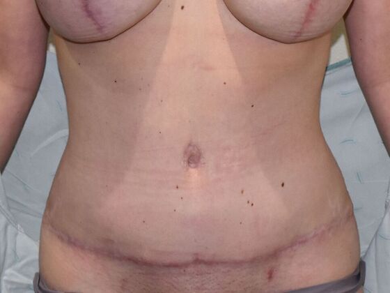 Tummy Tuck (Abdominoplasty): Case 504 - After