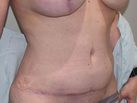 Tummy Tuck (Abdominoplasty): Case 504 - After