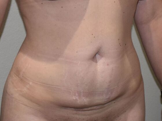 Tummy Tuck (Abdominoplasty): Case 504 - Before