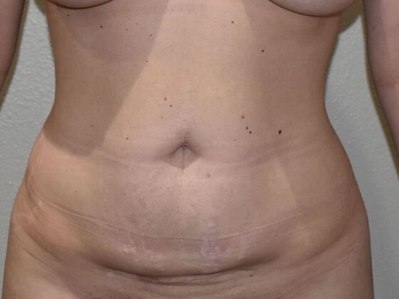 Tummy Tuck (Abdominoplasty): Case 504 - Before