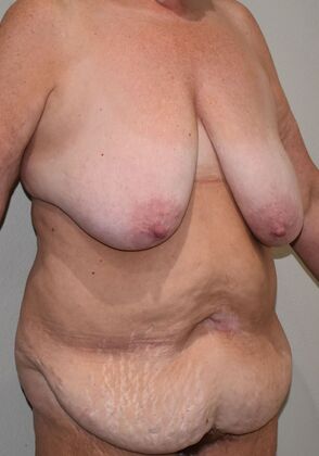 Mommy Makeover: Case 322 - Before