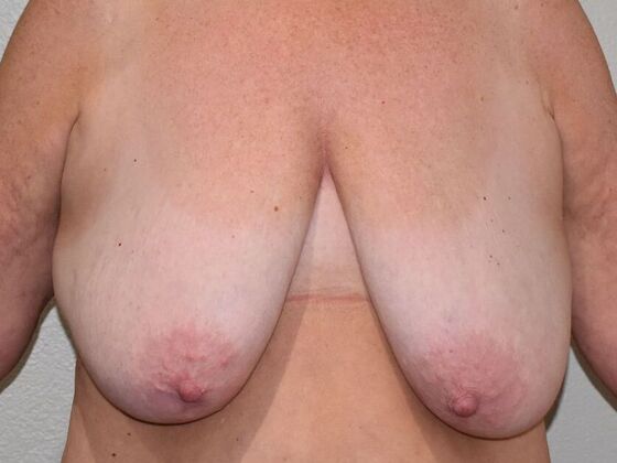 Breast Lift (Mastopexy) Case 226 - Before