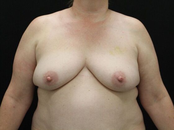 Breast Lift & Breast Lift Augmentation Case 46 - Before