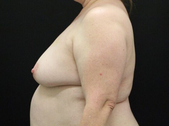 Breast Lift & Breast Lift Augmentation: Case 46 - Before