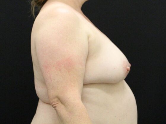 Breast Lift & Breast Lift Augmentation: Case 46 - Before