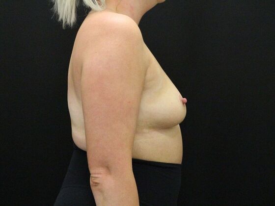 Breast Augmentation: Case 41 - Before