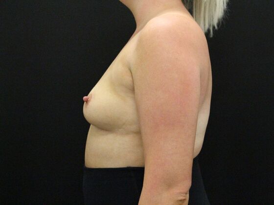 Breast Augmentation: Case 41 - Before