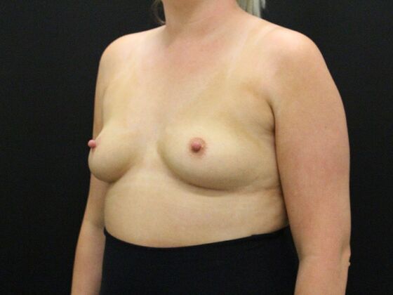 Breast Augmentation: Case 41 - Before
