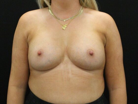 Breast Augmentation Case 41 - After