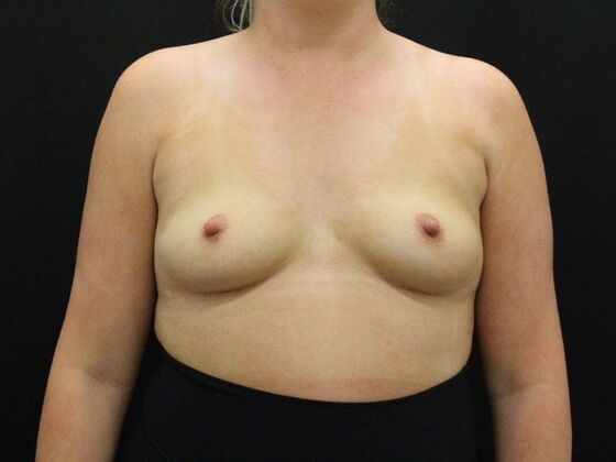 Breast Augmentation Case 41 - Before