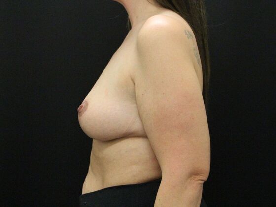Breast Lift & Breast Lift Augmentation: Case 25 - After