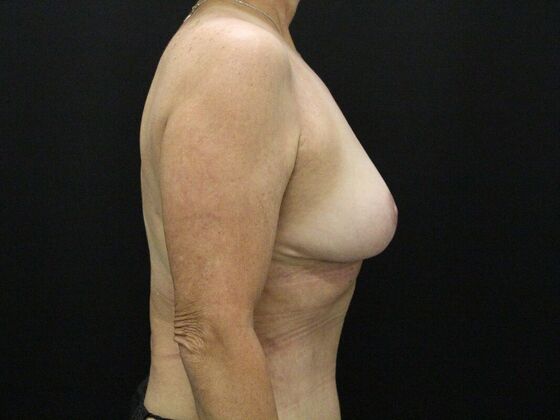 Breast Reduction & Lift: Case 28 - After