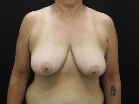 Breast Reduction & Lift Case 28 - Before