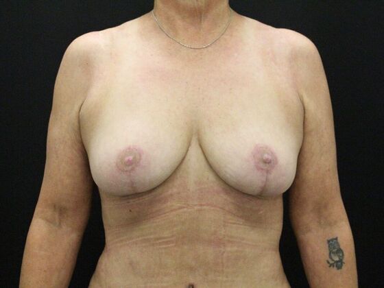 Breast Reduction & Lift Case 28 - After