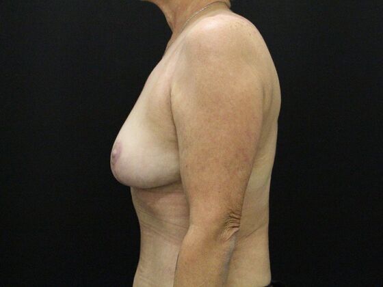 Breast Reduction & Lift: Case 28 - After